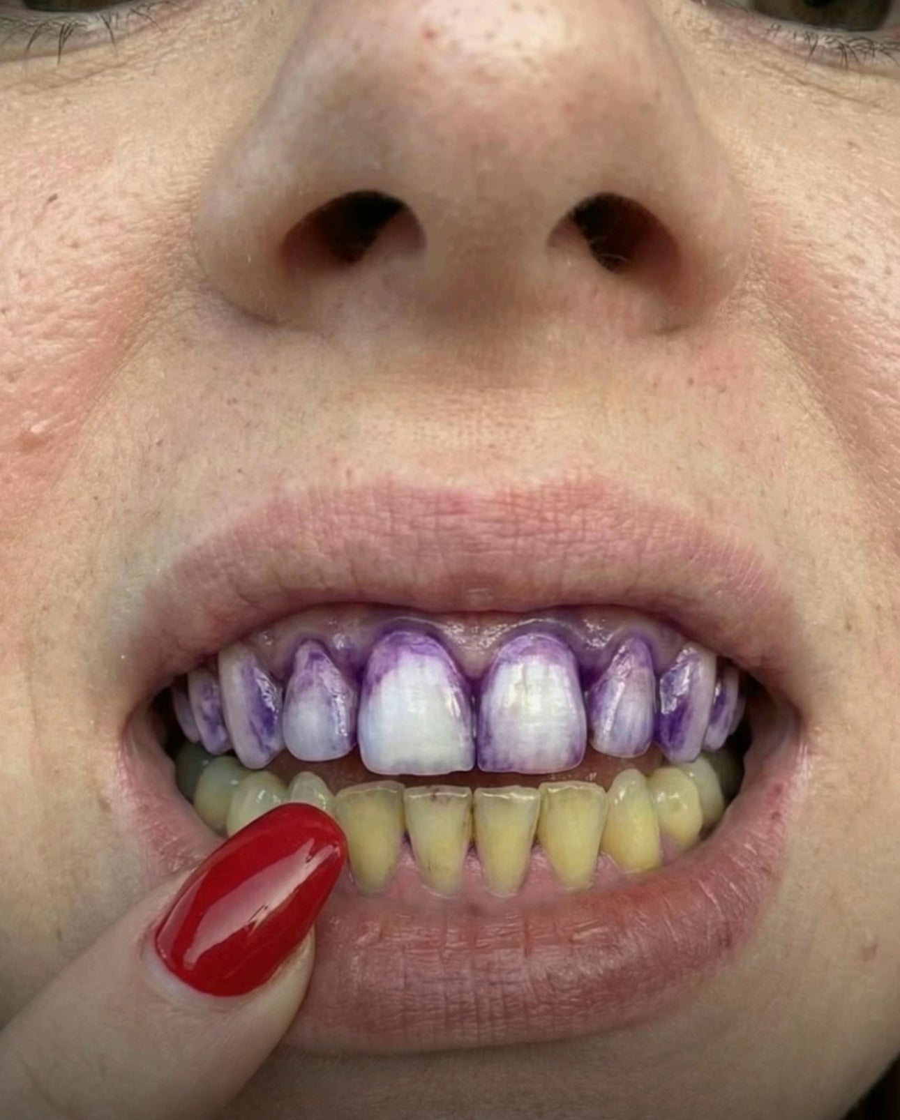 Purple Whitening Strips Color Correcting Technology